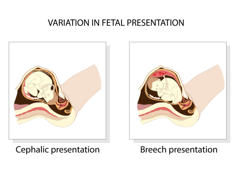 Does Back Pain During Pregnancy Lead To A C-Section? - Jacobs ...