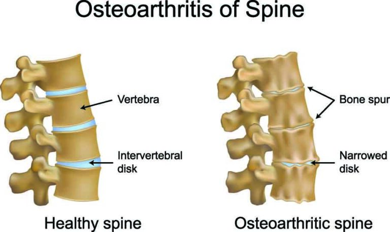 spine with disk map