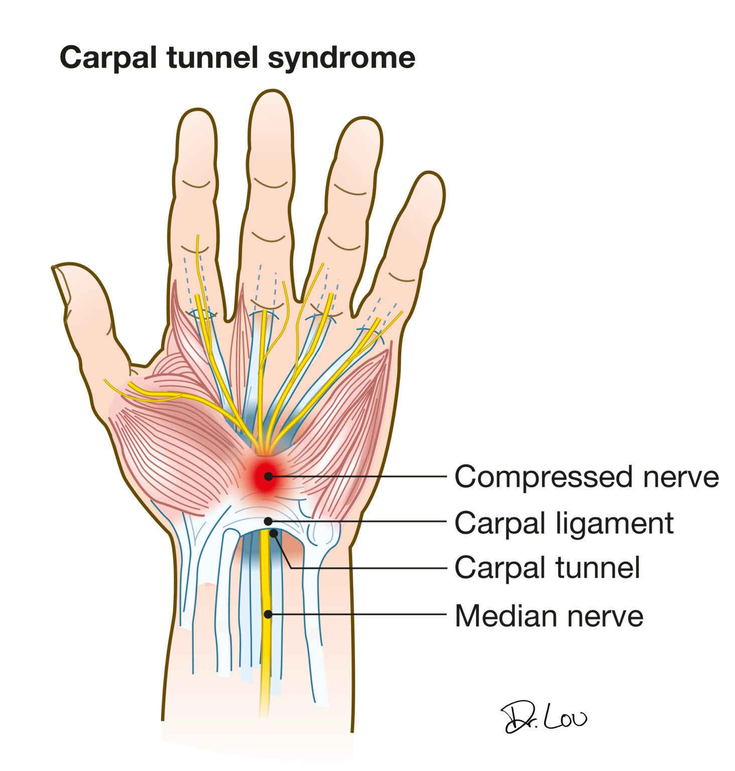 Carpal Tunnel Syndrome: The Guitar Player and Bass Player. - Jacobs ...