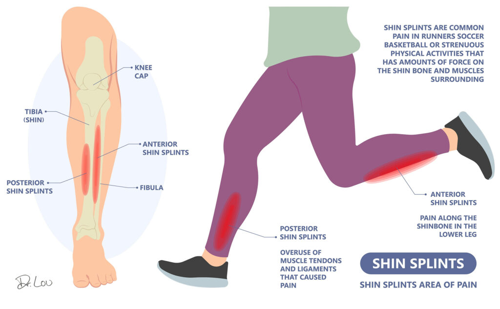 shin splints Jacobs Chiropractic Acupuncture